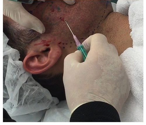 subcision birmingham 03 e1723973089760 | در مورد سابسیژن بیشتر بدانیم