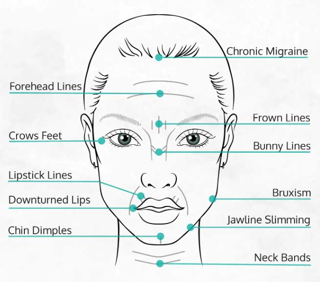 BOTOX | تزریق بوتاکس