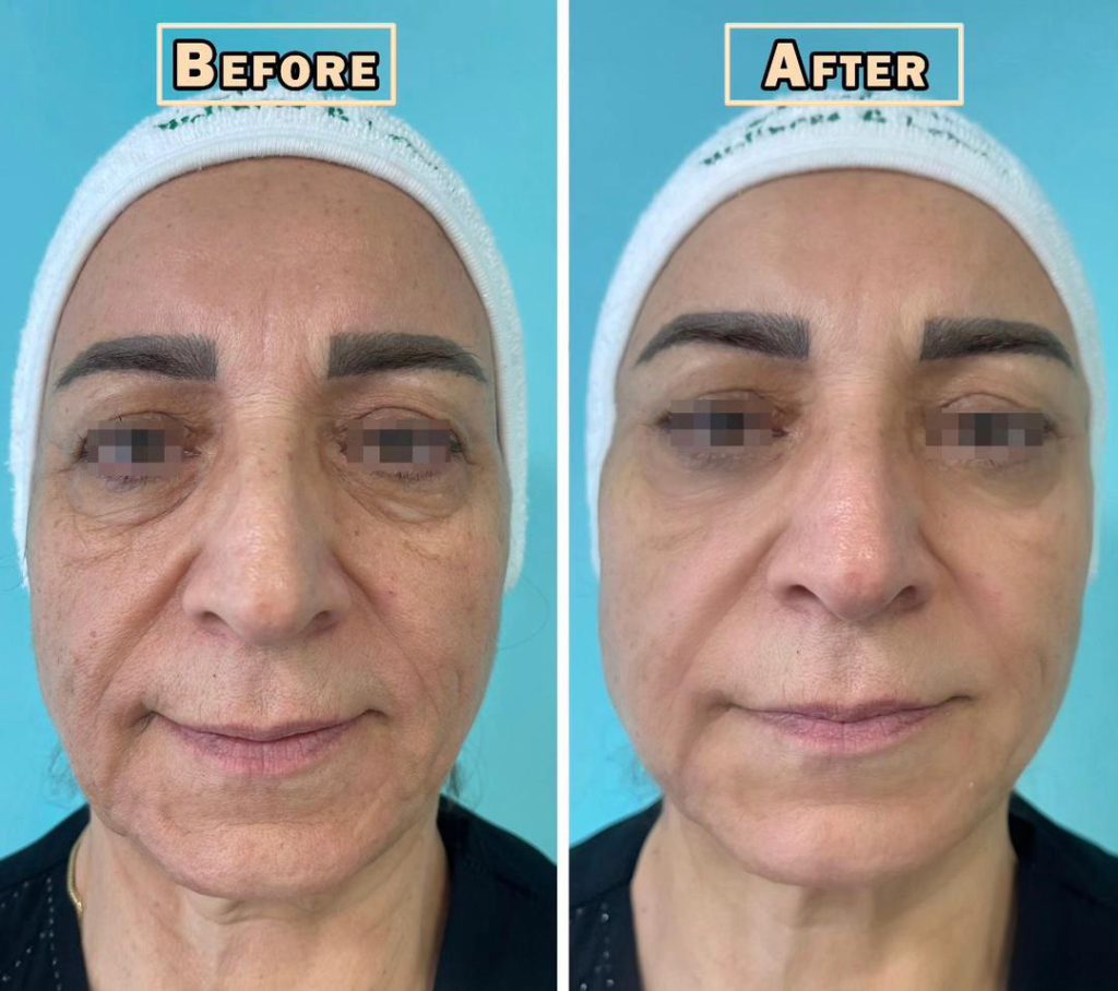 بهترین دکتر هایفو کرج