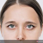 علت افتادگی ابروها چیست و چگونه می توان آنها را برطرف کرد؟